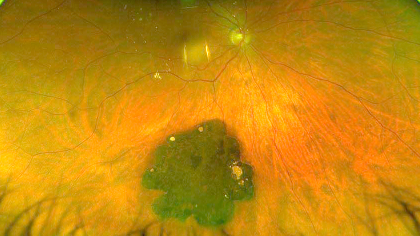 Congenital hypertrophy of the retinal pigment epithelium (CHRPE)