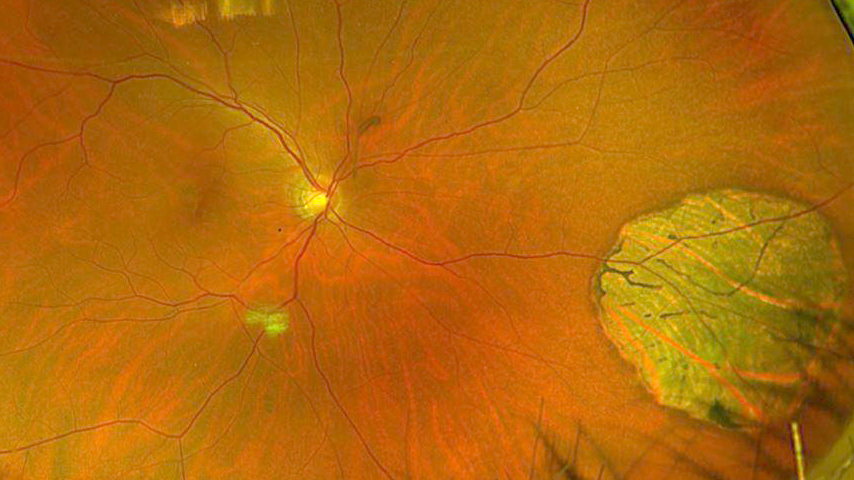 Congenital hypertrophy of the retinal pigment epithelium (CHRPE)