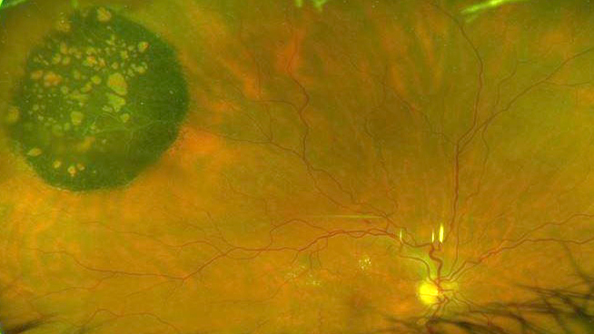 Congenital hypertrophy of the retinal pigment epithelium (CHRPE)