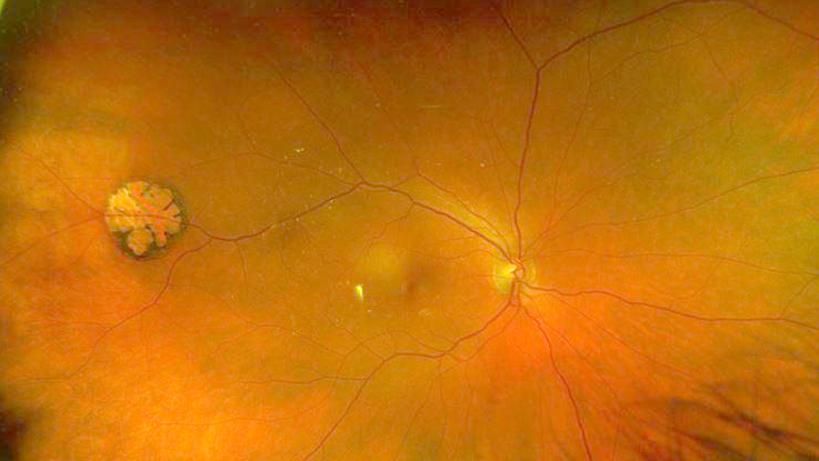 Congenital hypertrophy of the retinal pigment epithelium (CHRPE)