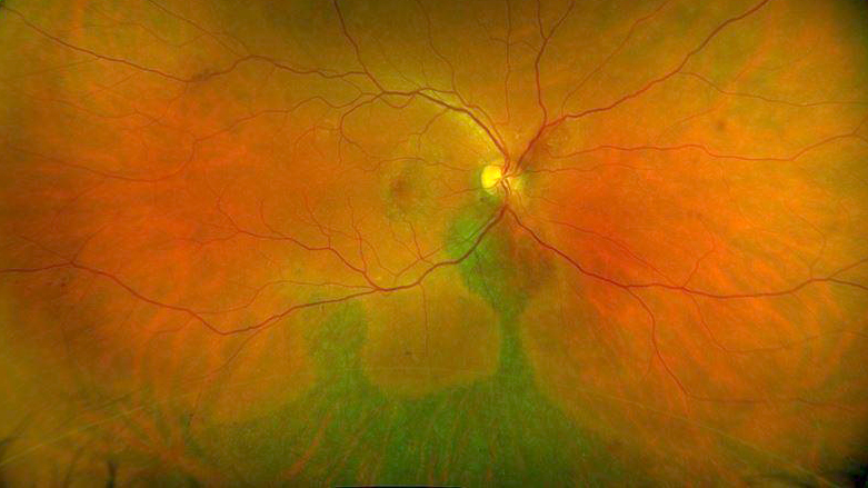 Chronic Central serous chorioretinopathy (CSCR)
