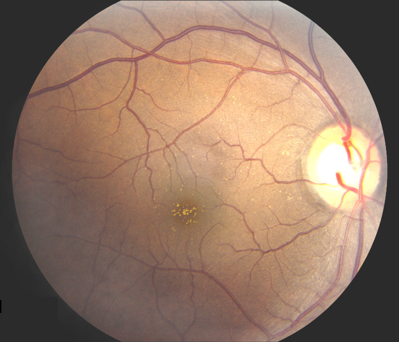Crystalline Retinopathy
