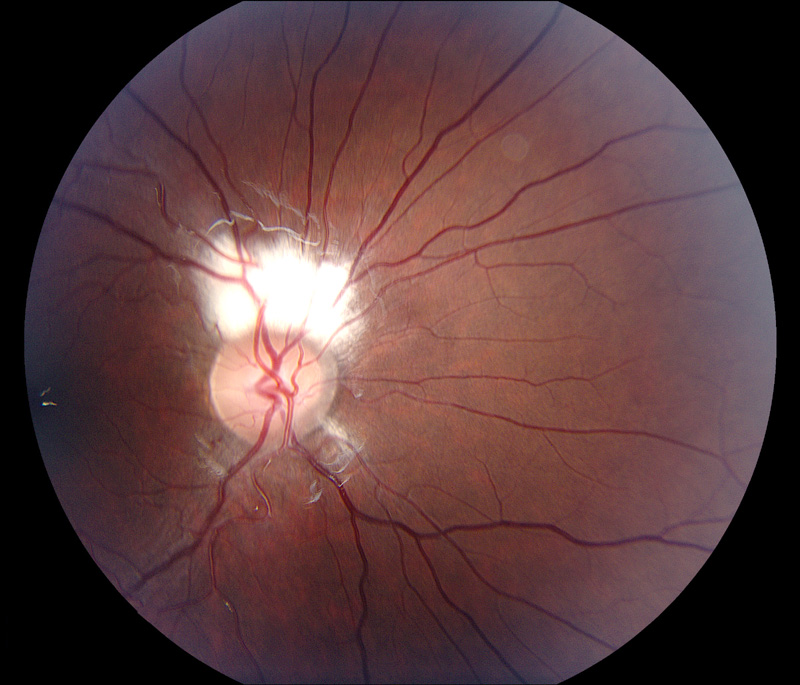 Myelinated retinal nerve fiber layer (RNFL)	