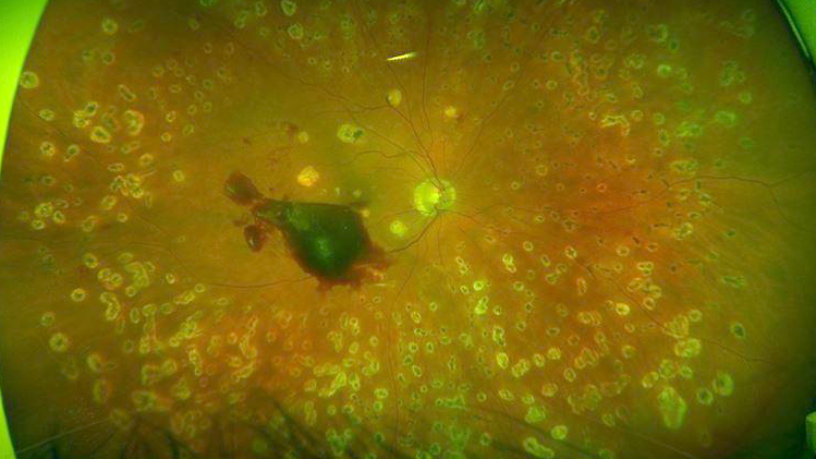 Subhyaloid hemorrhage in proliferative diabetic retinopathy