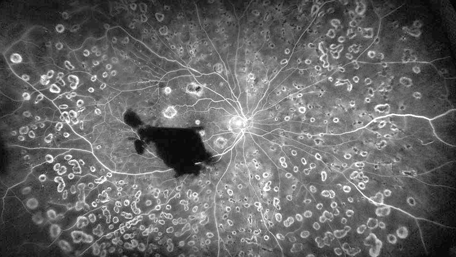 Subhyaloid hemorrhage in proliferative diabetic retinopathy (Fluoresceing angiography)