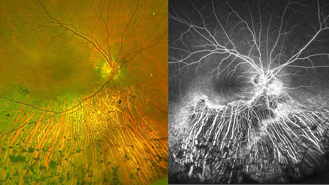 Sectoral Retinitis Pigmentosa